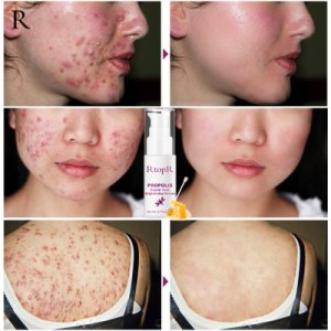 RtopR Propolis Repair Brightening Cleaning Shrink Pores Eliminates Acne Treatment Y3