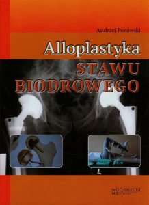 Alloplastyka stawu biodrowego Andrzej Pozowski
